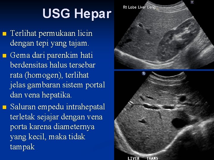 USG Hepar n n n Terlihat permukaan licin dengan tepi yang tajam. Gema dari