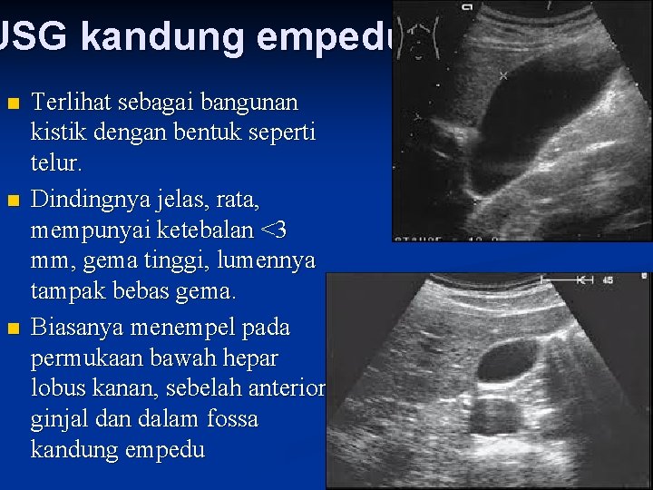 USG kandung empedu n n n Terlihat sebagai bangunan kistik dengan bentuk seperti telur.
