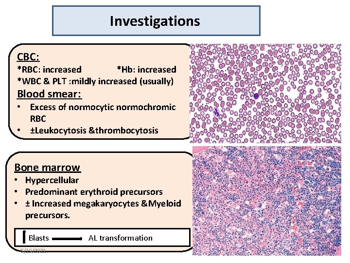 Investigations CBC: *RBC: increased *Hb: increased *WBC & PLT : mildly increased (usually) Blood