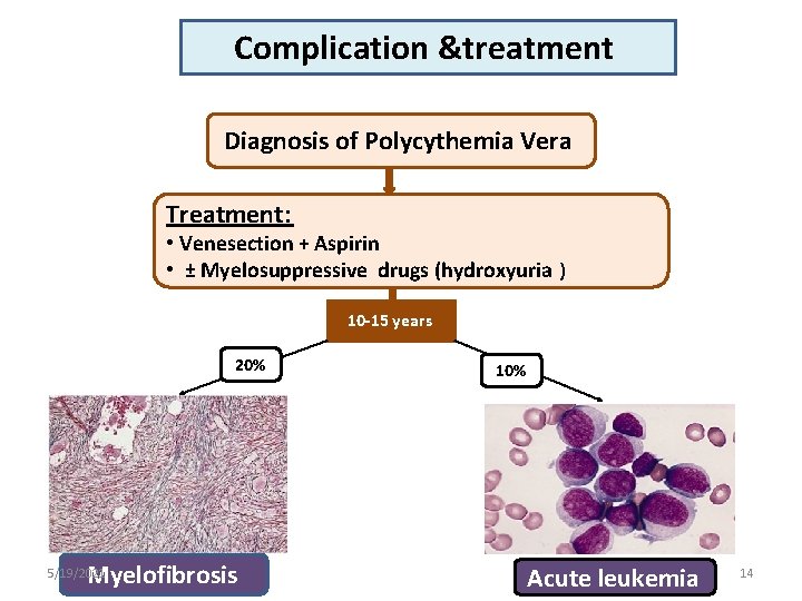 Complication &treatment Diagnosis of Polycythemia Vera Treatment: • Venesection + Aspirin • ± Myelosuppressive
