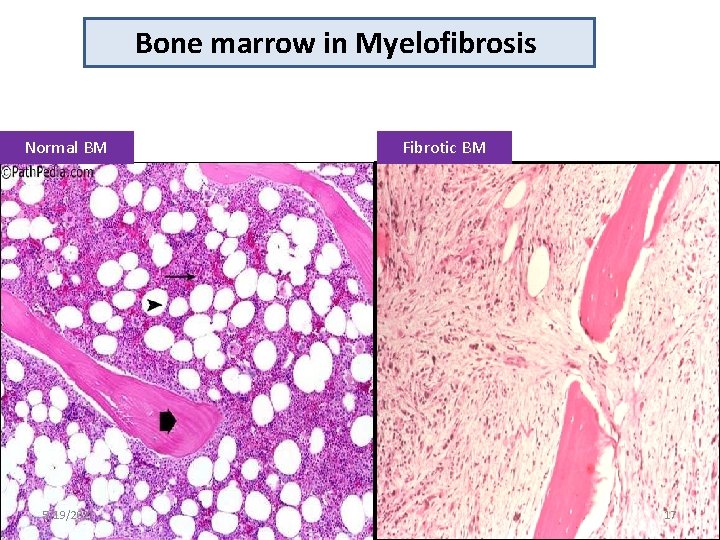 Bone marrow in Myelofibrosis Normal BM 5/19/2021 Fibrotic BM 17 