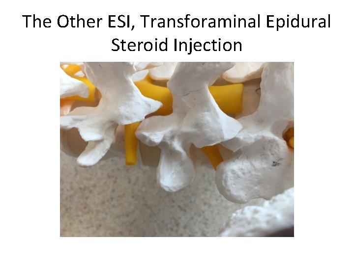 The Other ESI, Transforaminal Epidural Steroid Injection 
