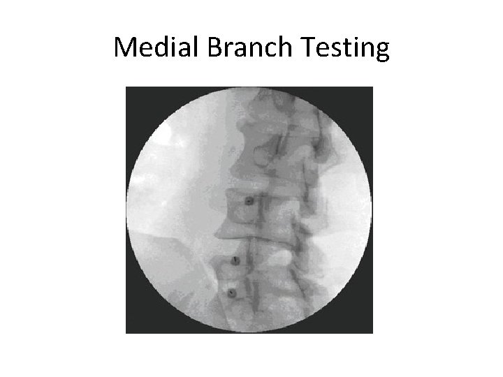 Medial Branch Testing 