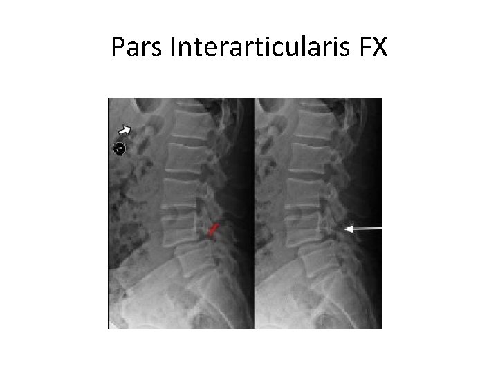 Pars Interarticularis FX 