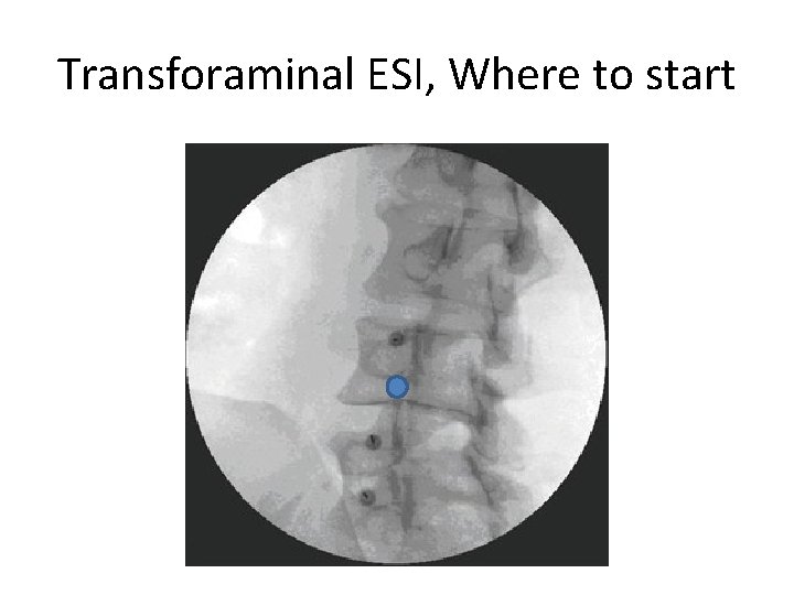Transforaminal ESI, Where to start 