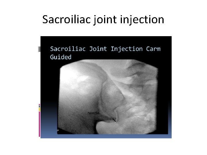 Sacroiliac joint injection 