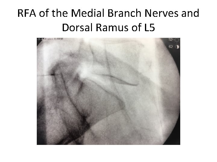 RFA of the Medial Branch Nerves and Dorsal Ramus of L 5 