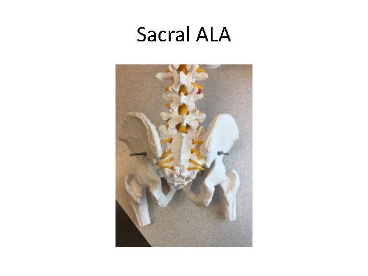 Sacral ALA 