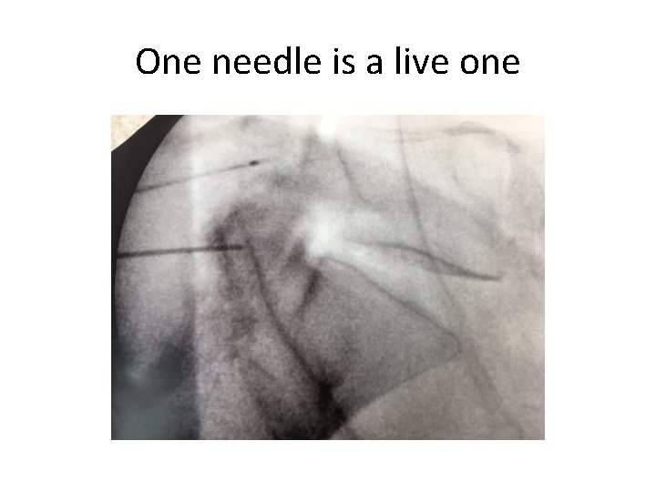 One needle is a live one 