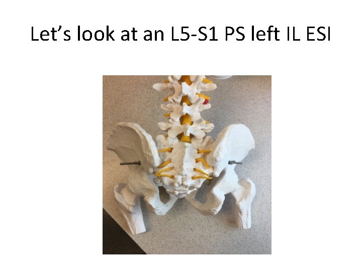 Let’s look at an L 5 -S 1 PS left IL ESI 
