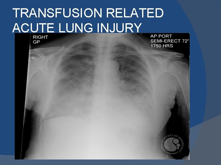 TRANSFUSION RELATED ACUTE LUNG INJURY 