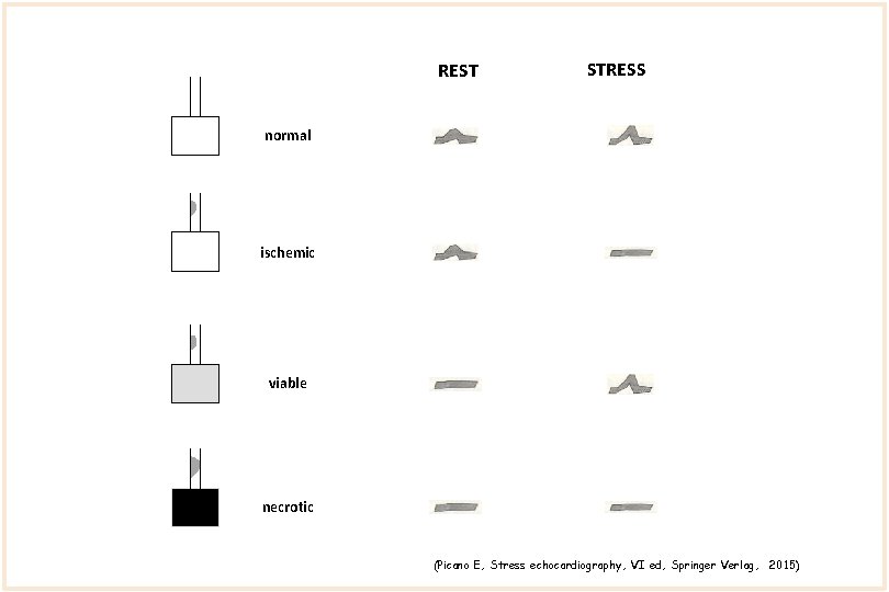 REST STRESS normal ischemic viable necrotic (Picano E, Stress echocardiography, VI ed, Springer Verlag,
