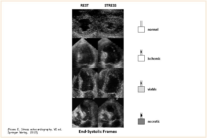REST STRESS normal ischemic viable necrotic (Picano E, Stress echocardiography, VI ed, Springer Verlag,