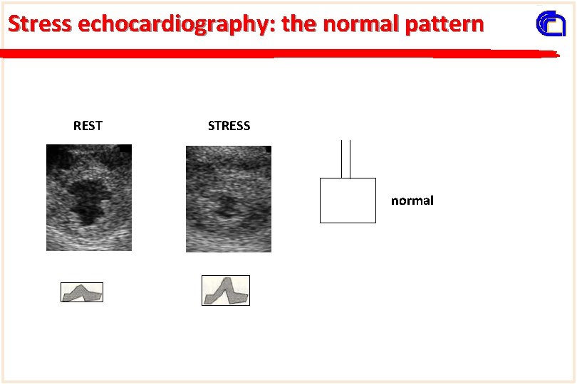 Stress echocardiography: the normal pattern REST STRESS normal 