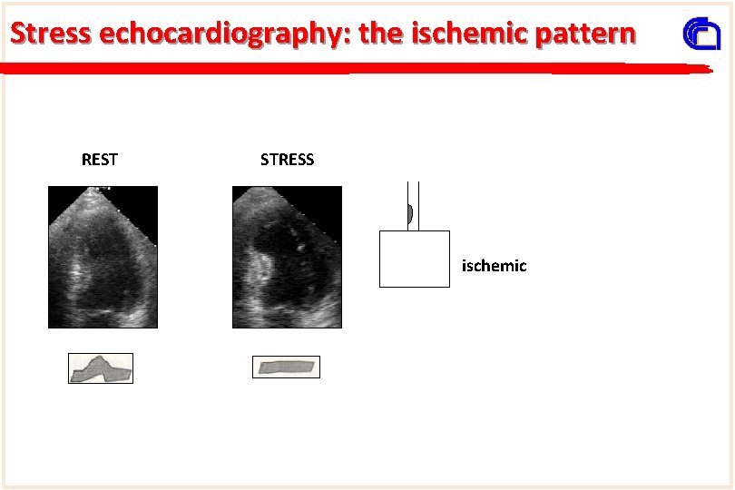Stress echocardiography: the ischemic pattern REST STRESS ischemic 