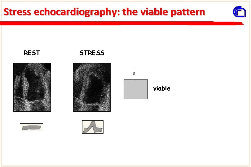 Stress echocardiography: the viable pattern REST STRESS viable 