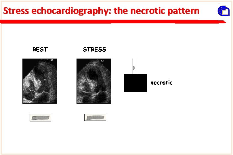 Stress echocardiography: the necrotic pattern REST STRESS necrotic 