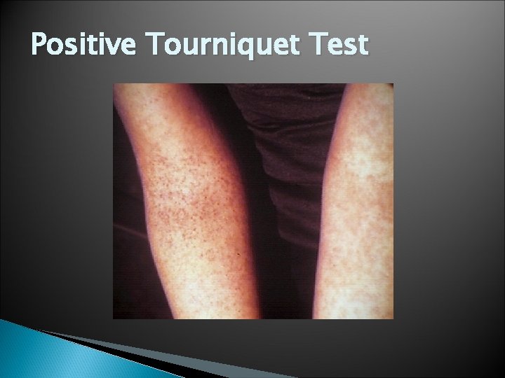 Positive Tourniquet Test 