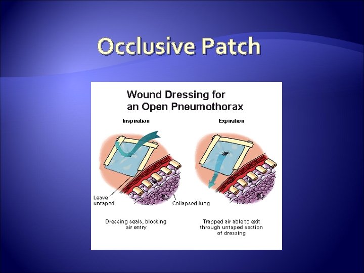 Occlusive Patch 