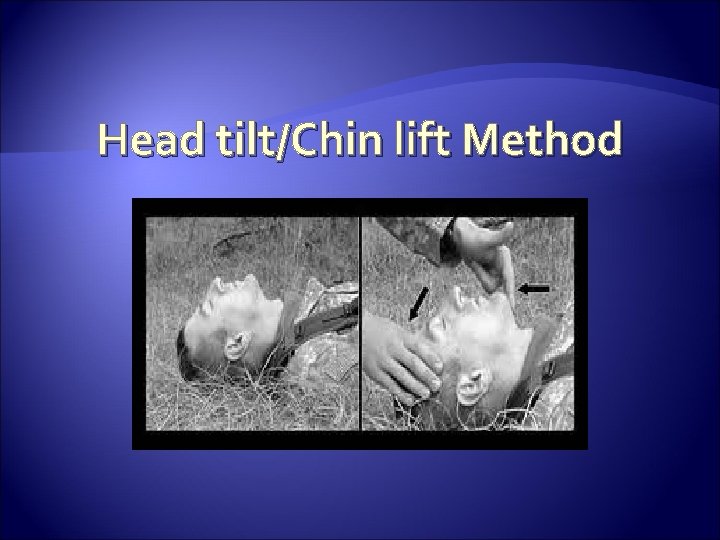 Head tilt/Chin lift Method 