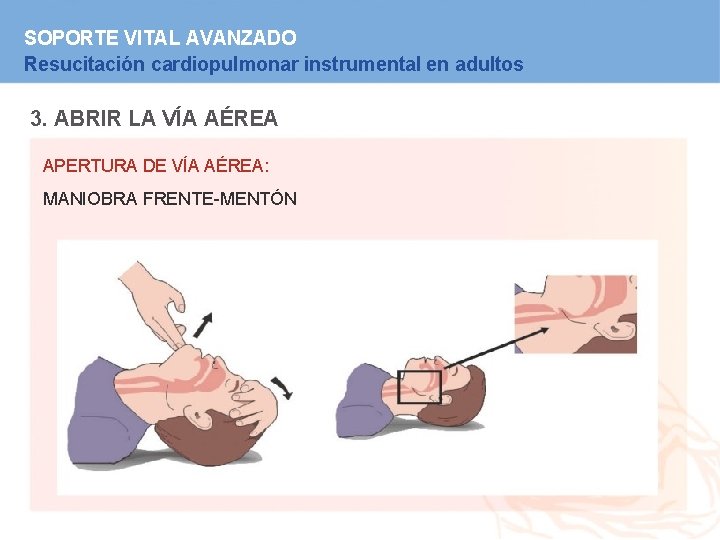 SOPORTE VITAL AVANZADO Resucitación cardiopulmonar instrumental en adultos 3. ABRIR LA VÍA AÉREA APERTURA