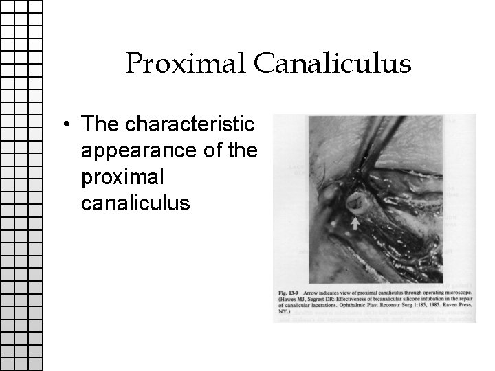Proximal Canaliculus • The characteristic appearance of the proximal canaliculus 