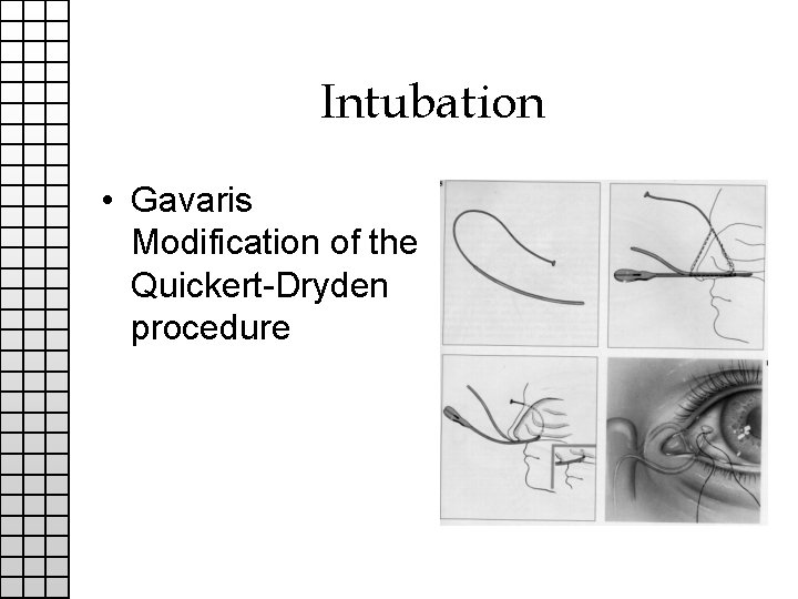 Intubation • Gavaris Modification of the Quickert-Dryden procedure 