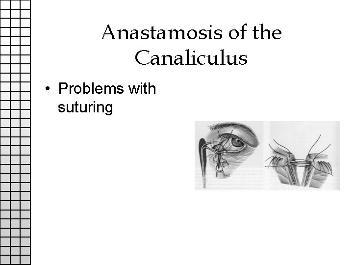 Anastamosis of the Canaliculus • Problems with suturing 