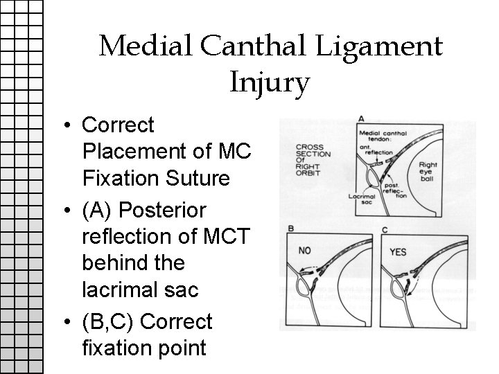 Medial Canthal Ligament Injury • Correct Placement of MC Fixation Suture • (A) Posterior