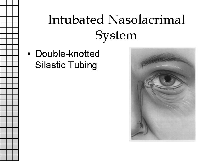 Intubated Nasolacrimal System • Double-knotted Silastic Tubing 