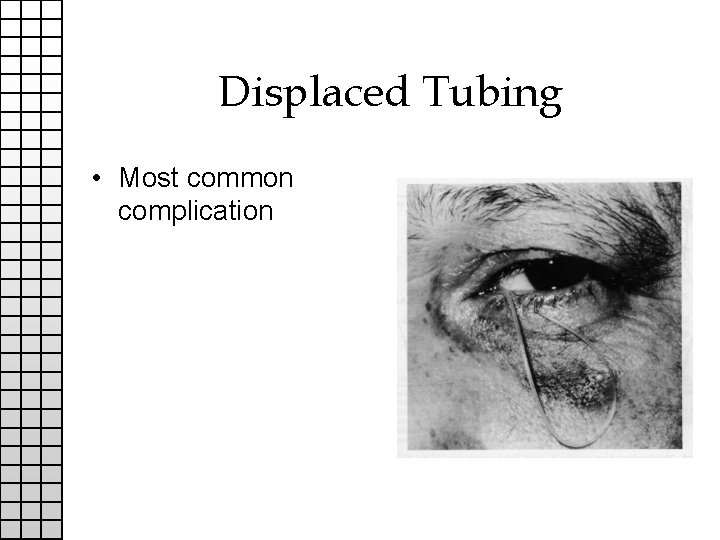 Displaced Tubing • Most common complication 