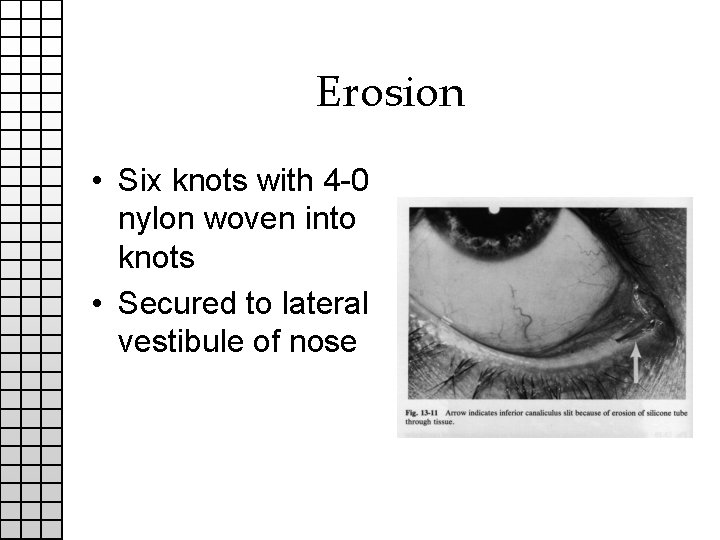 Erosion • Six knots with 4 -0 nylon woven into knots • Secured to