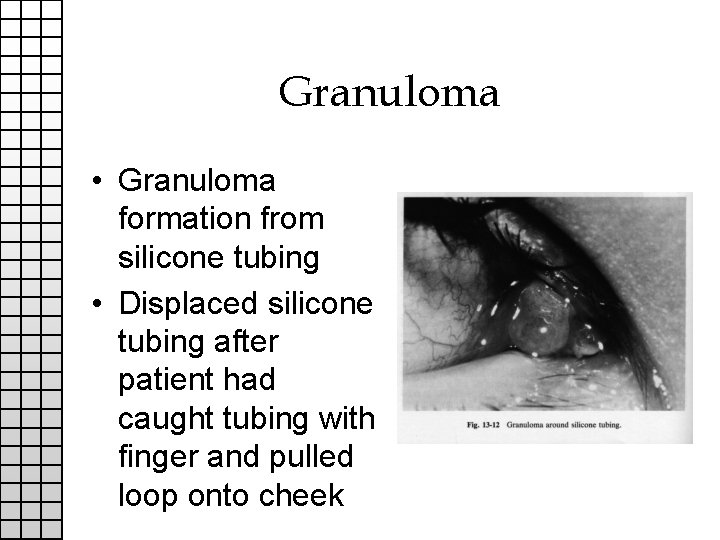 Granuloma • Granuloma formation from silicone tubing • Displaced silicone tubing after patient had