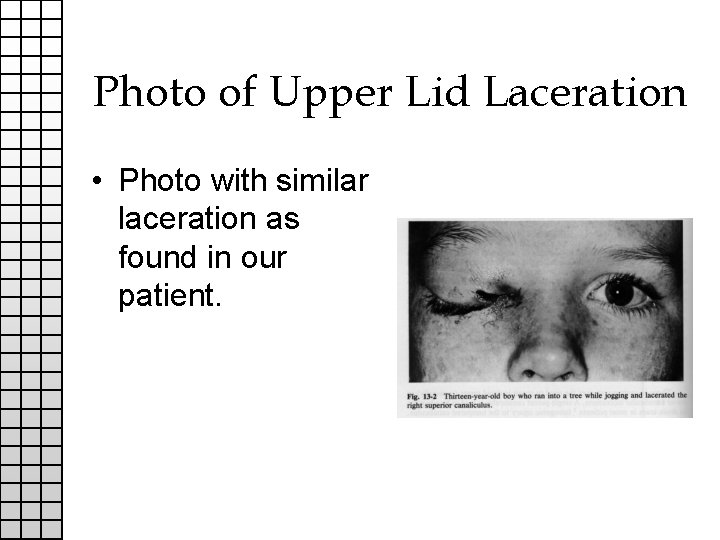 Photo of Upper Lid Laceration • Photo with similar laceration as found in our