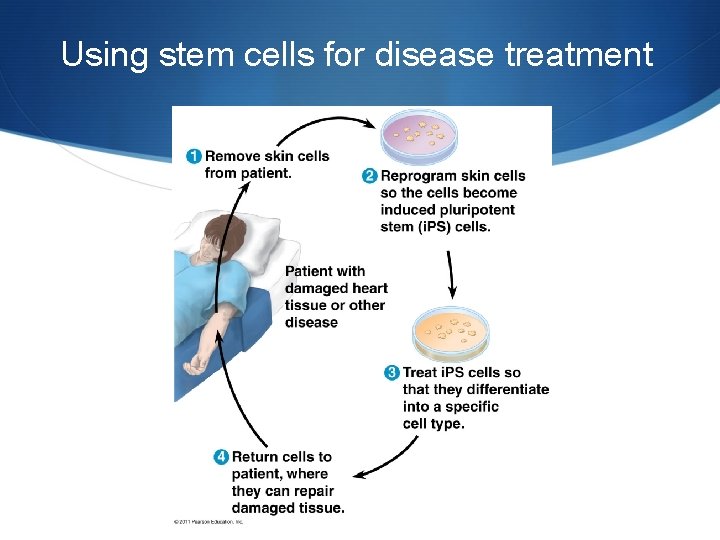 Using stem cells for disease treatment 