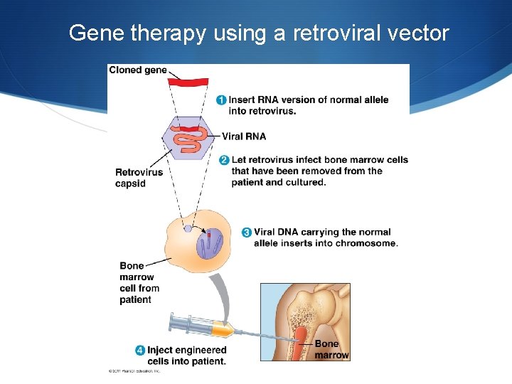Gene therapy using a retroviral vector 