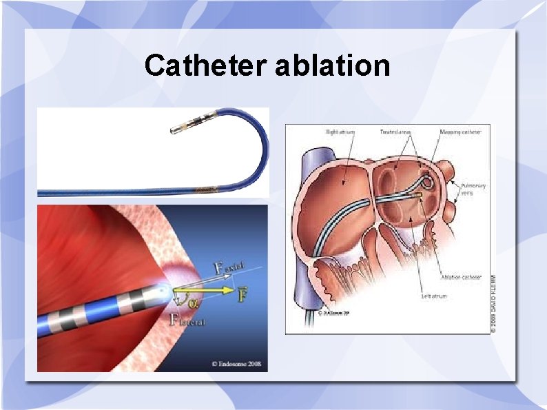 Catheter ablation 