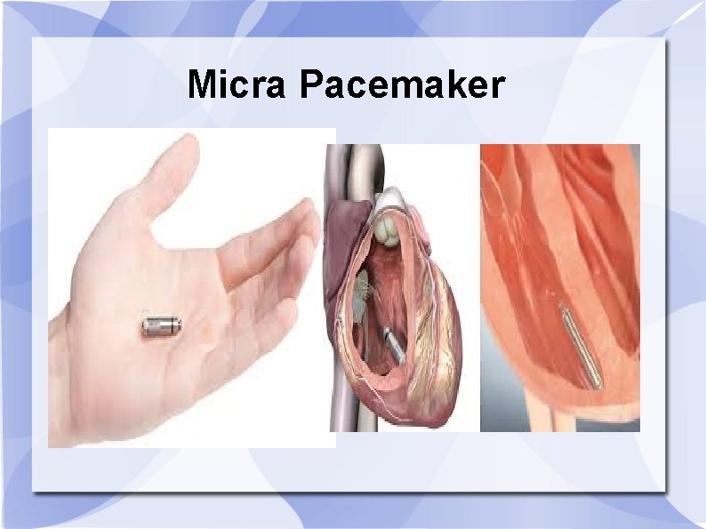 Micra Pacemaker 