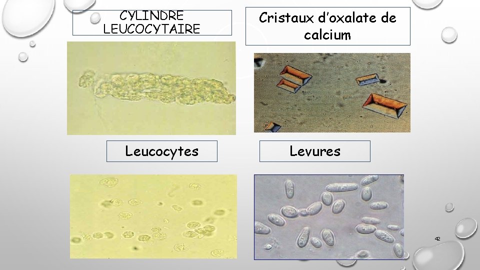 CYLINDRE LEUCOCYTAIRE Leucocytes Cristaux d’oxalate de calcium Levures 42 