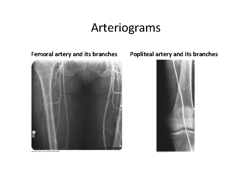 Arteriograms Femoral artery and its branches Popliteal artery and its branches 