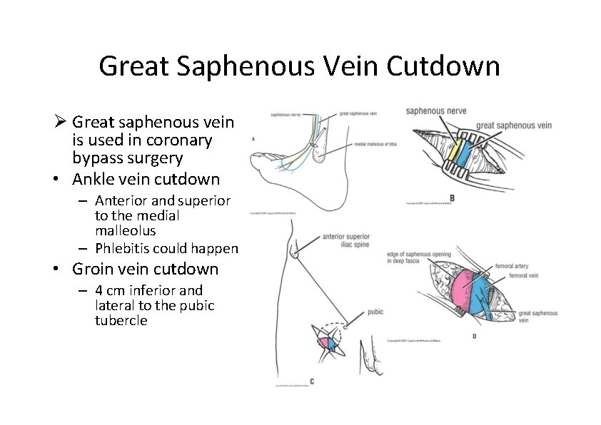 Great Saphenous Vein Cutdown Great saphenous vein is used in coronary bypass surgery •