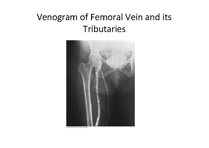Venogram of Femoral Vein and its Tributaries 
