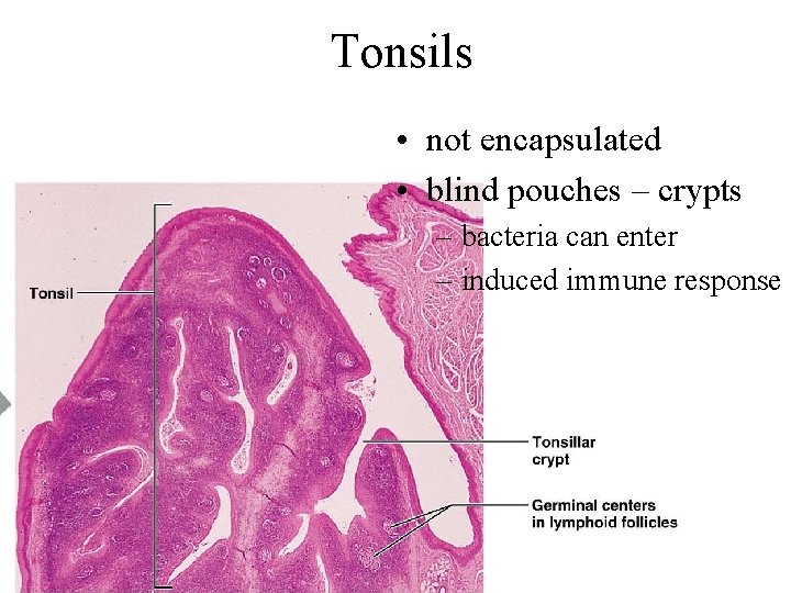 Tonsils • not encapsulated • blind pouches – crypts – bacteria can enter –
