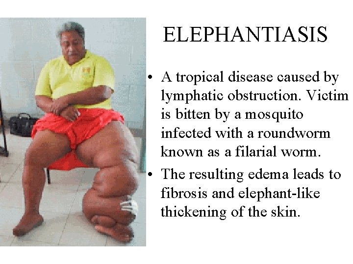 ELEPHANTIASIS • A tropical disease caused by lymphatic obstruction. Victim is bitten by a