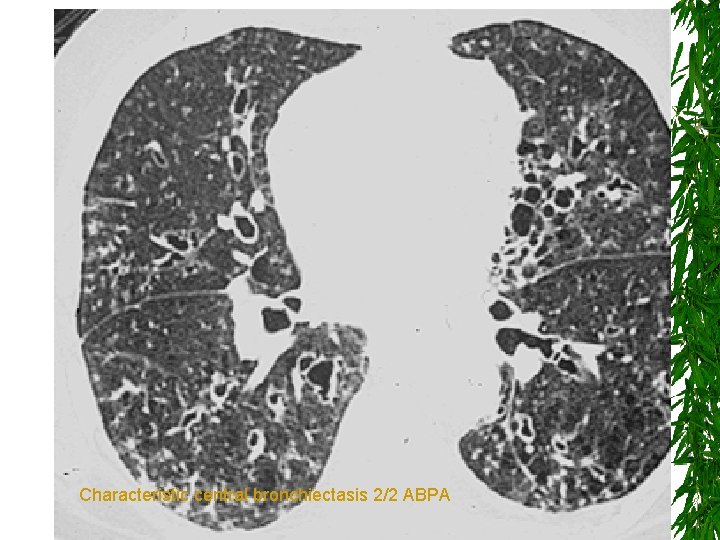 Characteristic central bronchiectasis 2/2 ABPA 