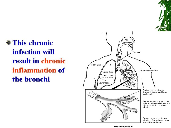 This chronic infection will result in chronic inflammation of the bronchi 