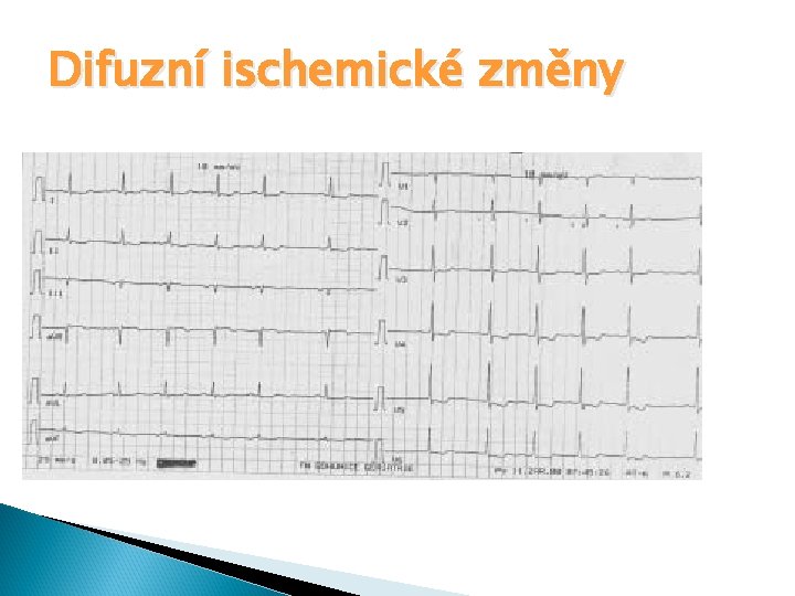 Difuzní ischemické změny 