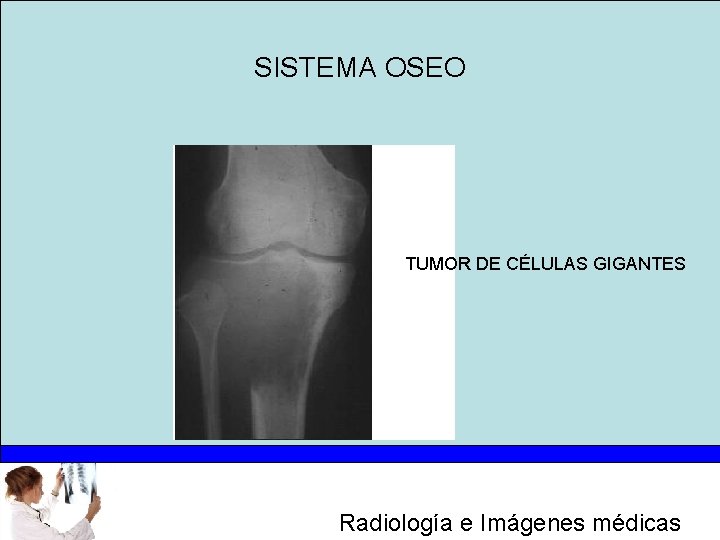 SISTEMA OSEO TUMOR DE CÉLULAS GIGANTES Radiología e Imágenes médicas 