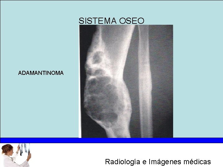 SISTEMA OSEO ADAMANTINOMA Radiología e Imágenes médicas 