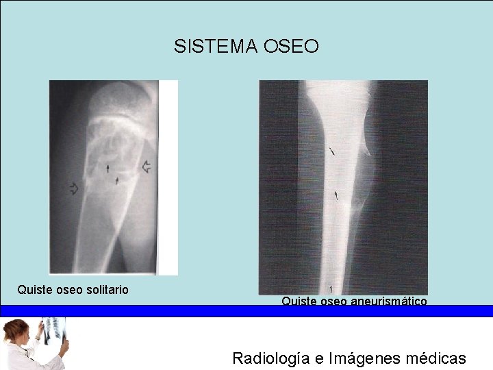 SISTEMA OSEO Quiste oseo solitario Quiste oseo aneurismático Radiología e Imágenes médicas 